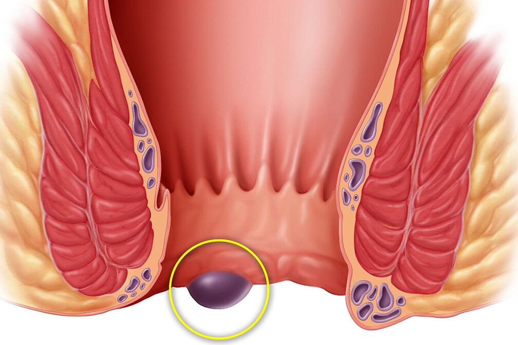 haemorrhoids